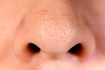 How to Remove Blackheads | 9 Easy Tips to Get Rid of Blackheads