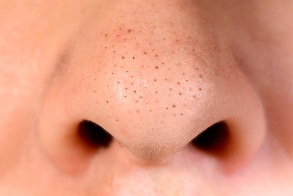 How to Remove Blackheads | 9 Easy Tips to Get Rid of Blackheads